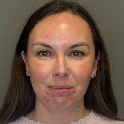 BioRePeel Before & After Gallery - Patient 450555 - Image 1