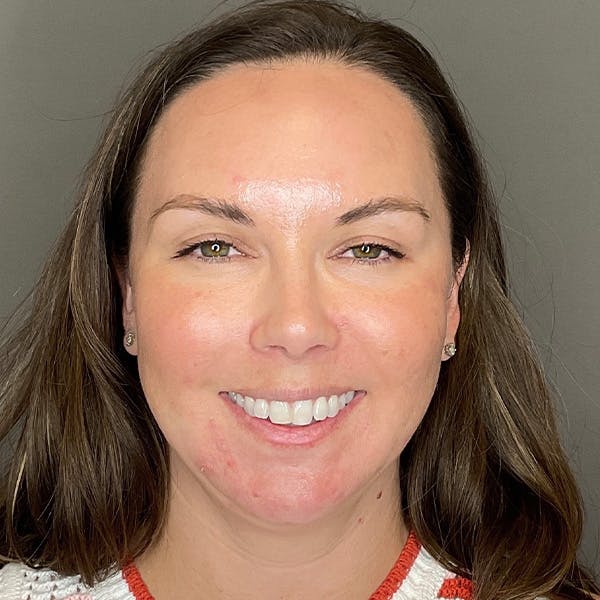 BioRePeel Before & After Gallery - Patient 450555 - Image 2