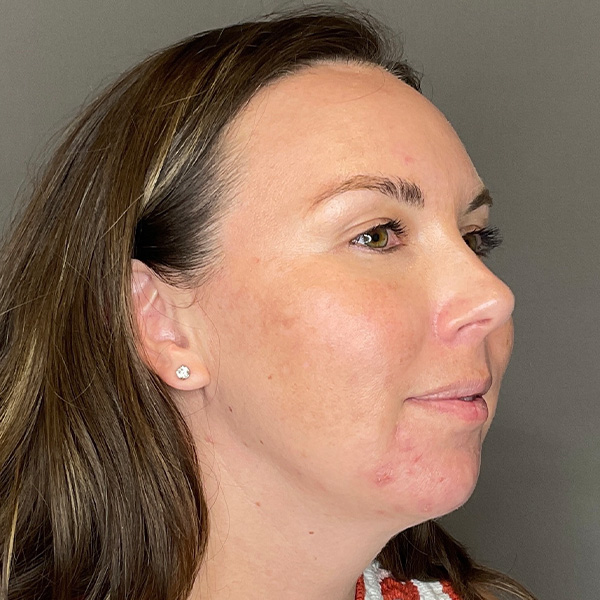 BioRePeel Before & After Gallery - Patient 450555 - Image 4