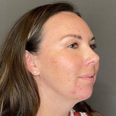 BioRePeel Before & After Gallery - Patient 450555 - Image 4