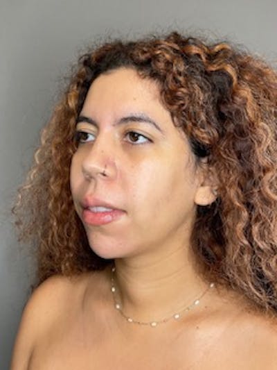 Chin Before & After Gallery - Patient 179654 - Image 6