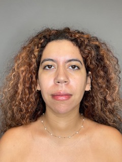 Chin Before & After Gallery - Patient 179654 - Image 2