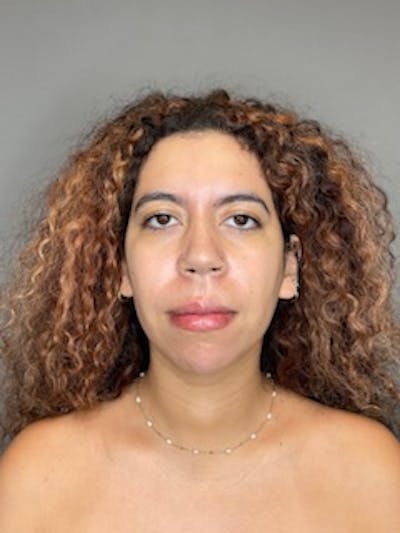 Chin Before & After Gallery - Patient 179654 - Image 2