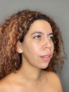 Chin Before & After Gallery - Patient 179654 - Image 4