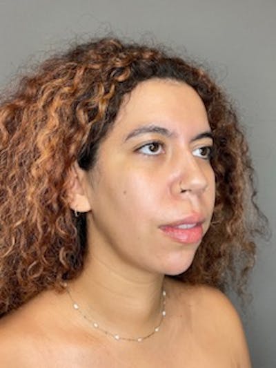 Chin Before & After Gallery - Patient 179654 - Image 4