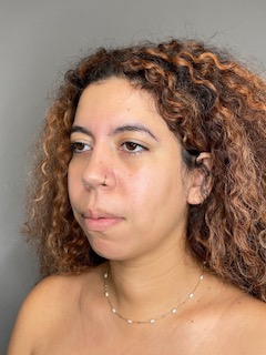 Chin Before & After Gallery - Patient 179654 - Image 5