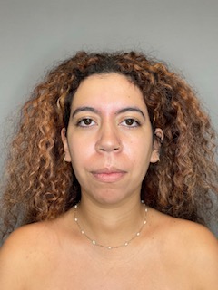 Chin Before & After Gallery - Patient 179654 - Image 1