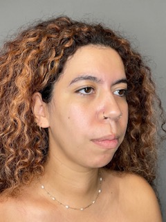 Chin Before & After Gallery - Patient 179654 - Image 3