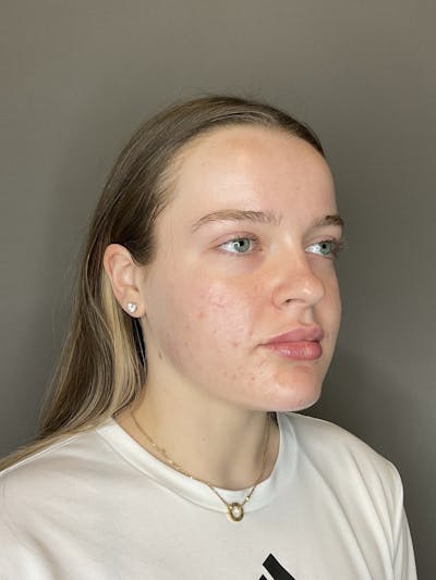 Lip Fillers Before & After Gallery - Patient 293707 - Image 4