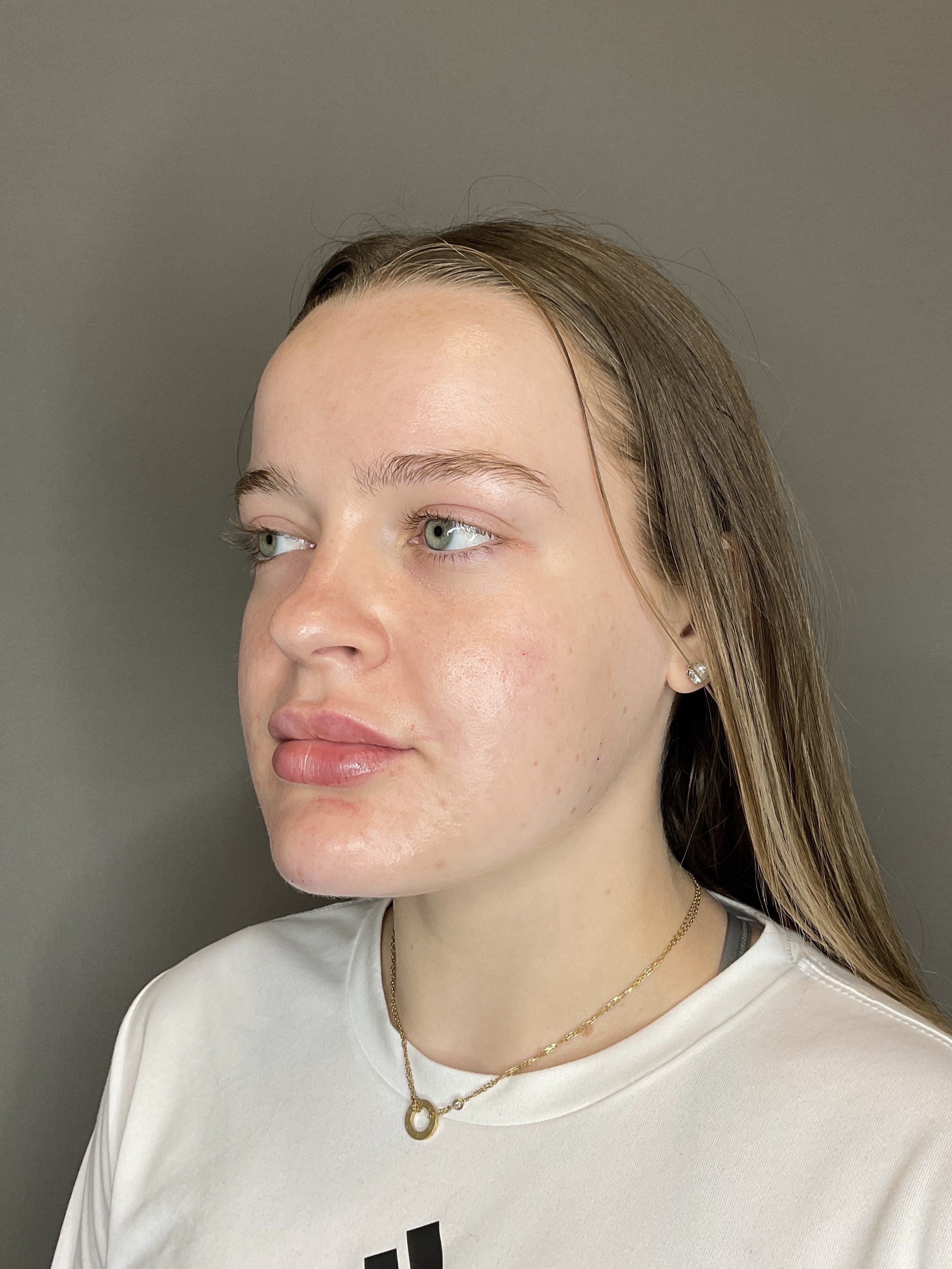 Lip Fillers Before & After Gallery - Patient 293707 - Image 6