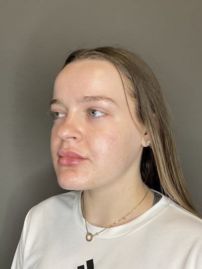 Lip Fillers Before & After Gallery - Patient 293707 - Image 6