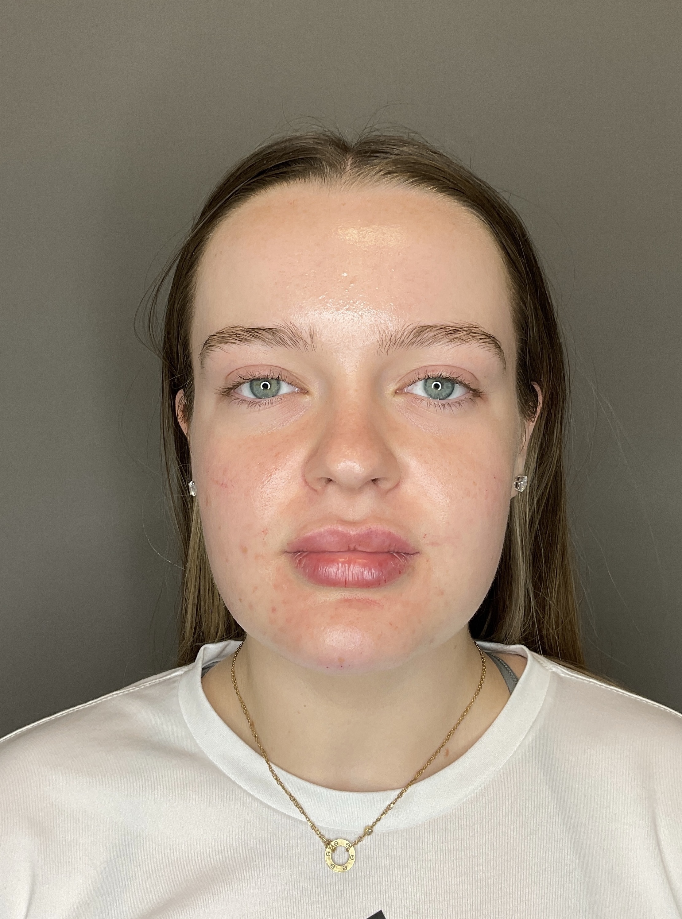 Lip Fillers Before & After Gallery - Patient 293707 - Image 2