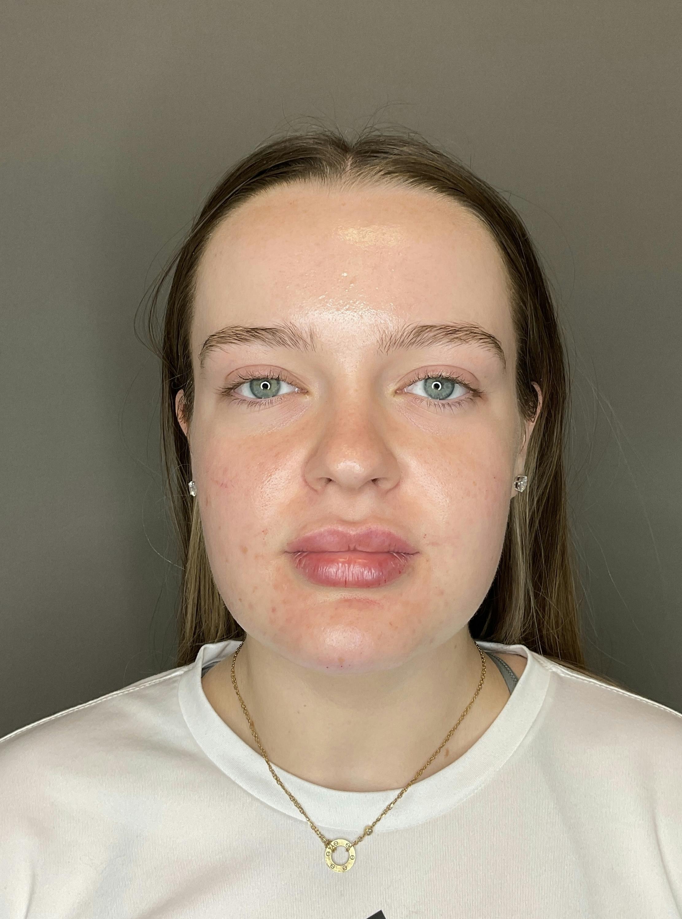 Lip Fillers Before & After Gallery - Patient 293707 - Image 2