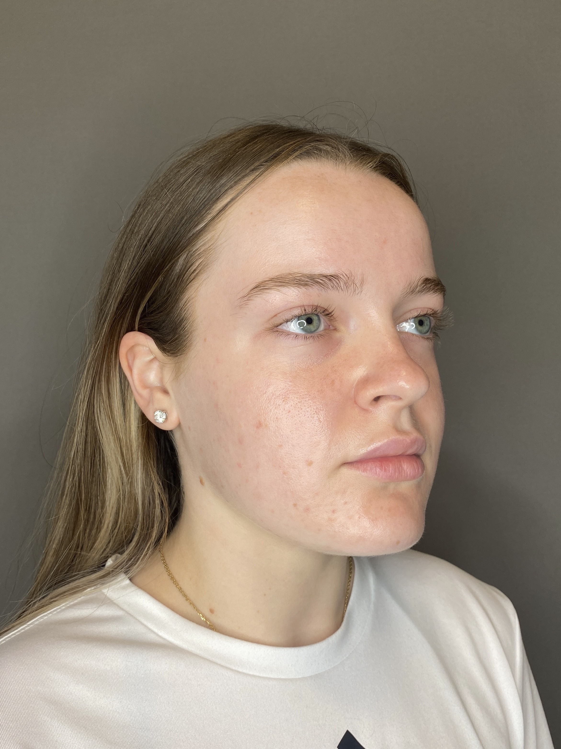 Lip Fillers Before & After Gallery - Patient 293707 - Image 3