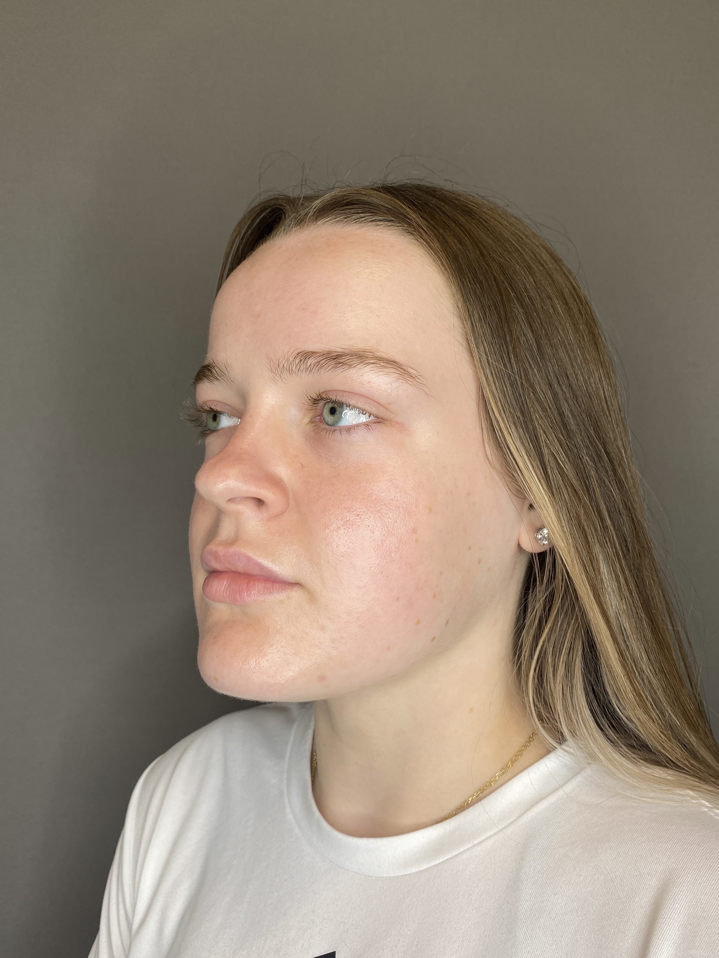 Lip Fillers Before & After Gallery - Patient 293707 - Image 5