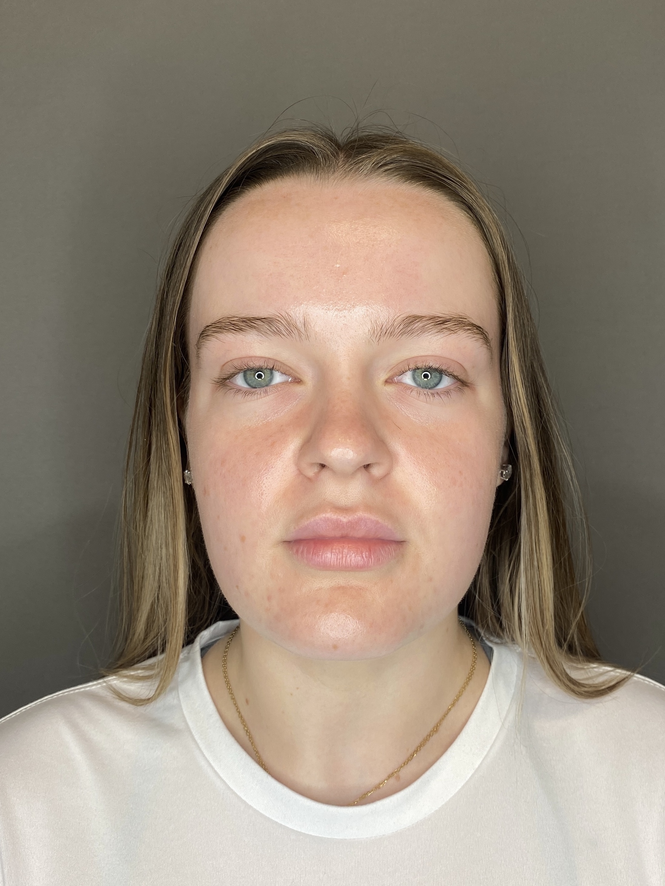 Lip Fillers Before & After Gallery - Patient 293707 - Image 1
