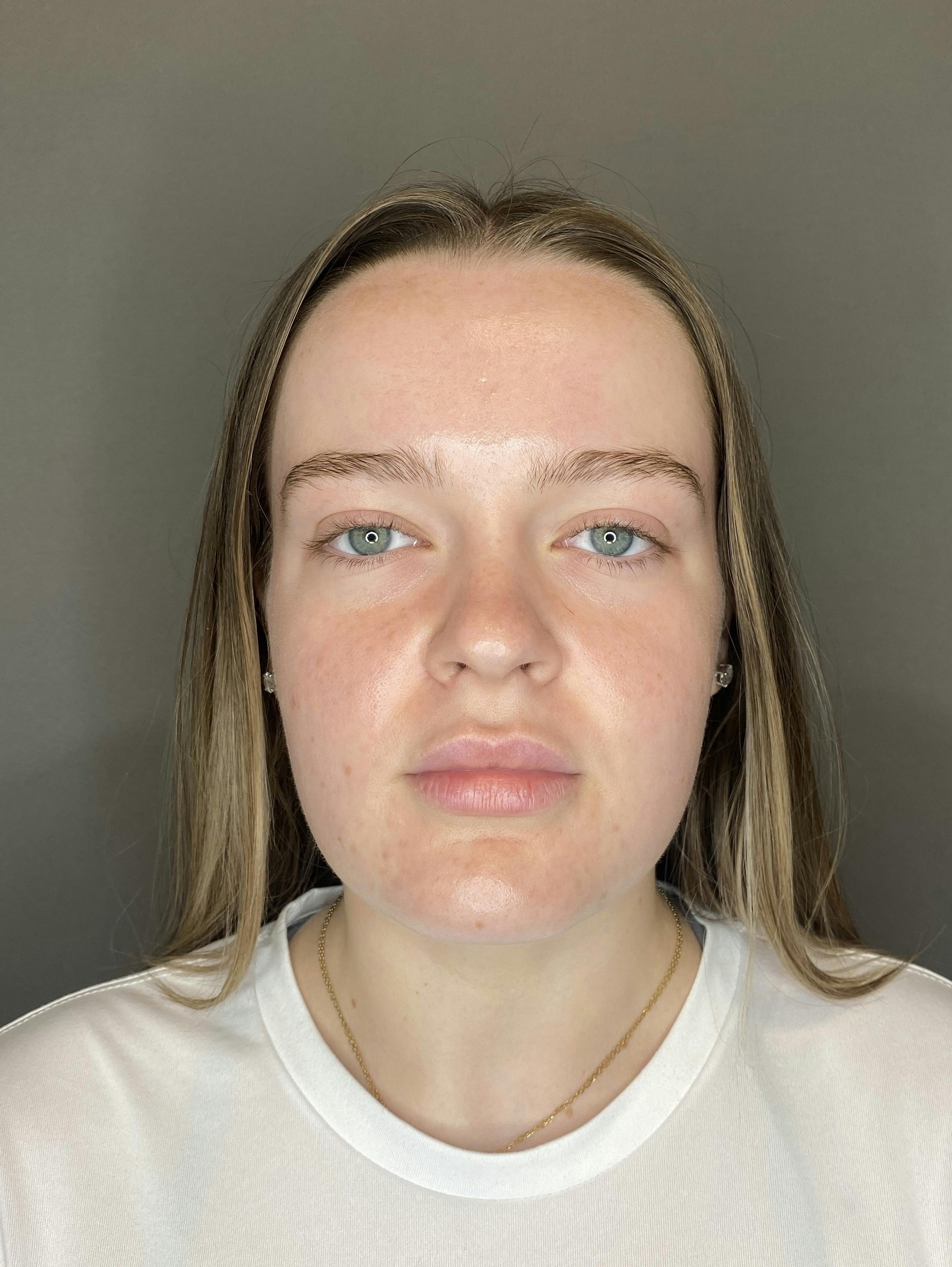 Lip Fillers Before & After Gallery - Patient 293707 - Image 1