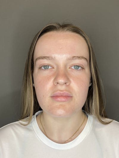 Lip Fillers Before & After Gallery - Patient 293707 - Image 1