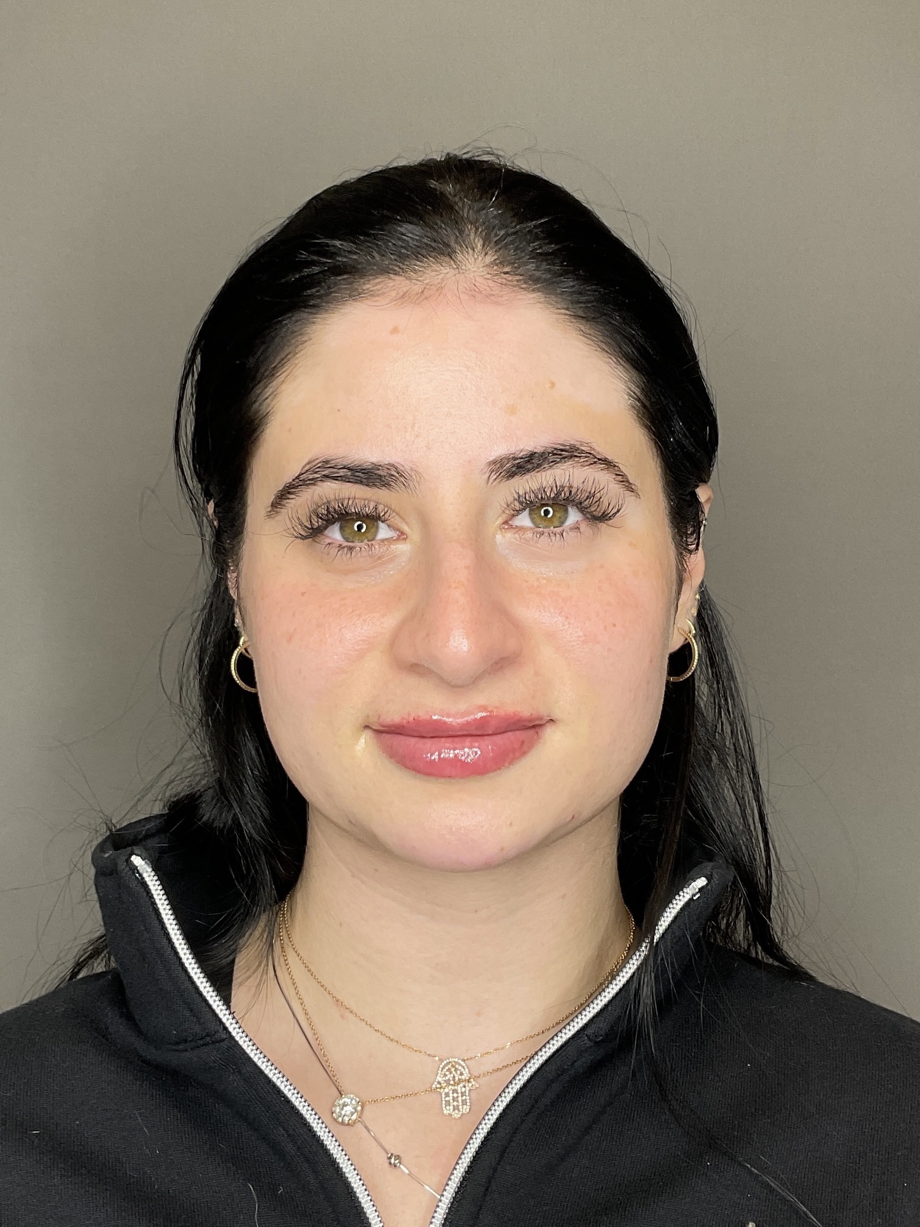 Lip Fillers Before & After Gallery - Patient 478470 - Image 2