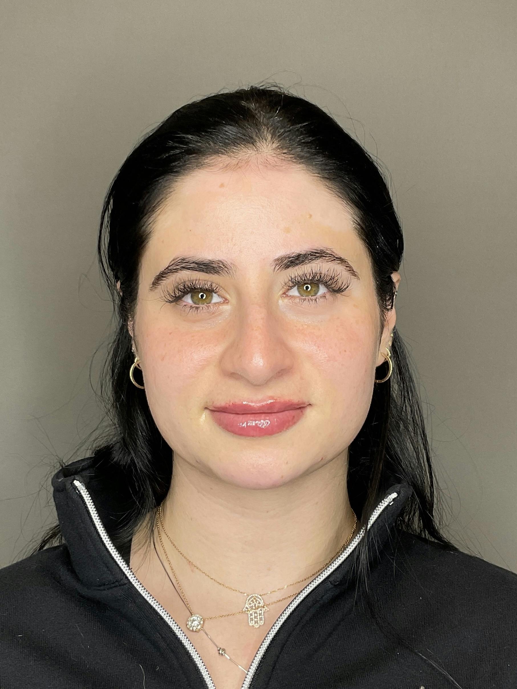 Lip Fillers Before & After Gallery - Patient 478470 - Image 2