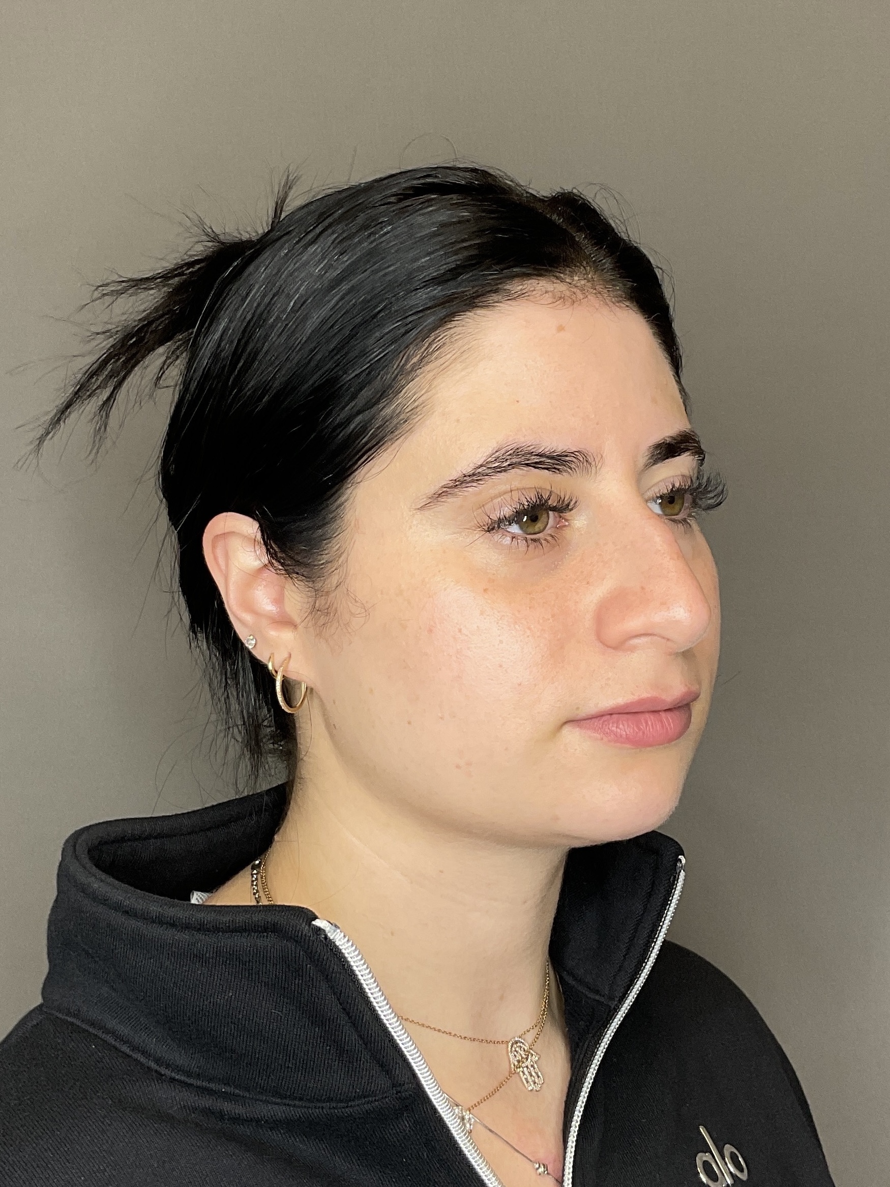 Lip Fillers Before & After Gallery - Patient 478470 - Image 3