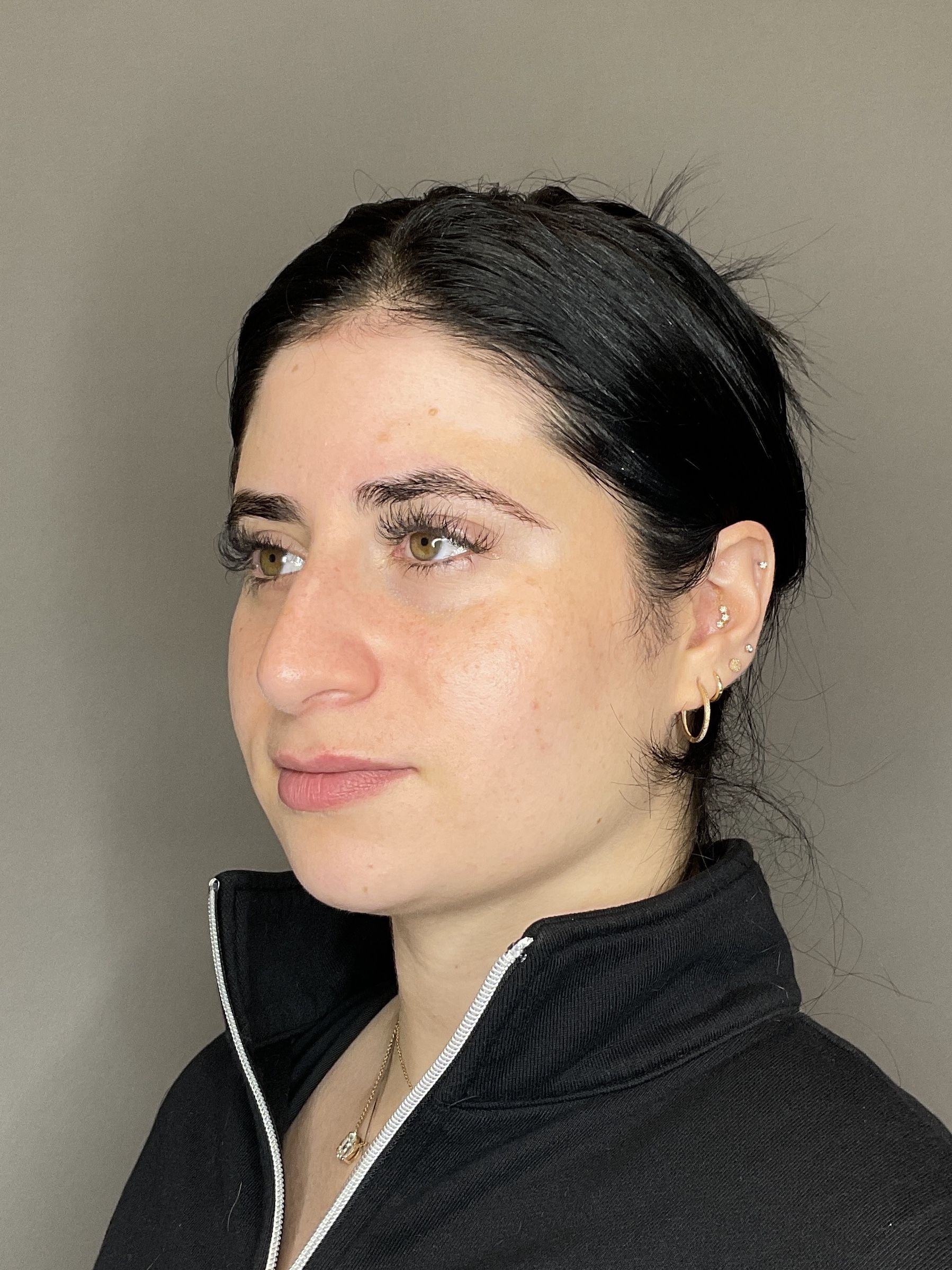 Lip Fillers Before & After Gallery - Patient 478470 - Image 5