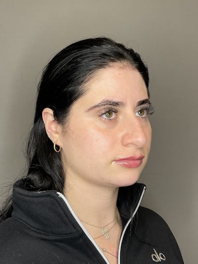 Lip Fillers Before & After Gallery - Patient 478470 - Image 4