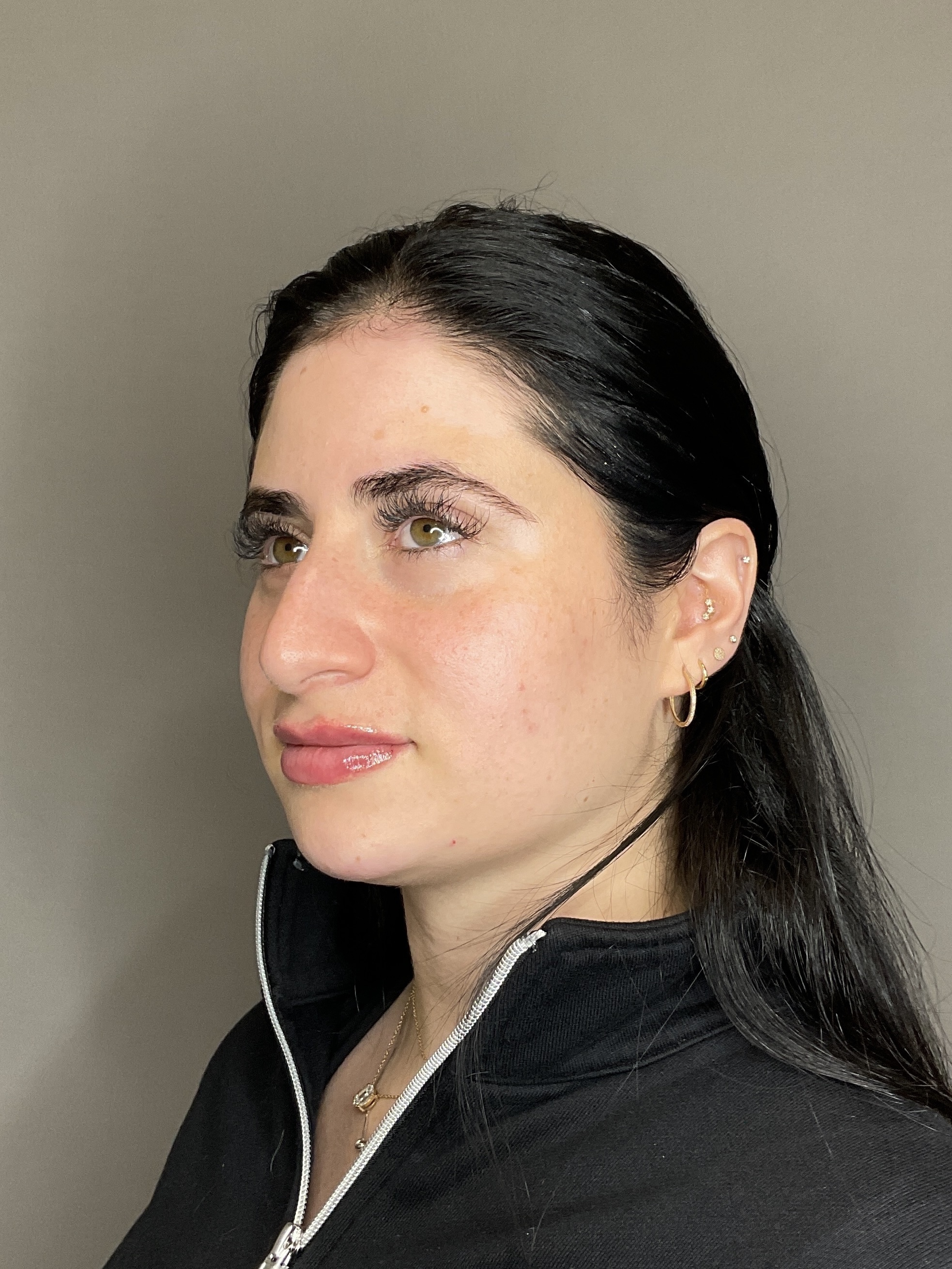 Lip Fillers Before & After Gallery - Patient 478470 - Image 6