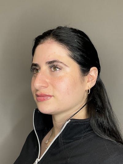 Lip Fillers Before & After Gallery - Patient 478470 - Image 6