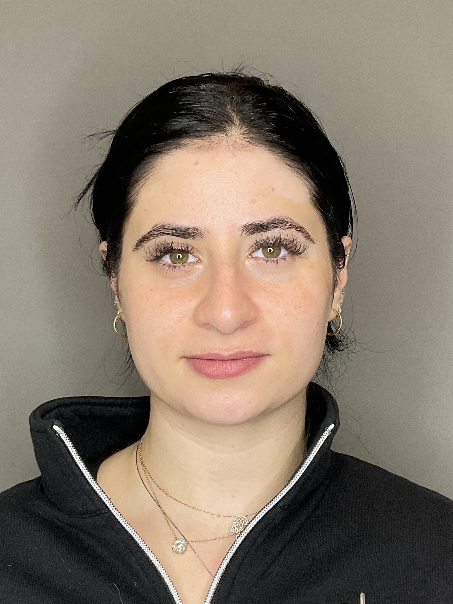 Lip Fillers Before & After Gallery - Patient 478470 - Image 1