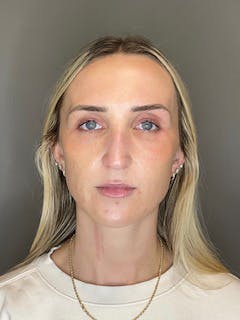 Sculptra Before & After Gallery - Patient 519244 - Image 1