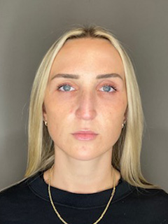 Sculptra Before & After Gallery - Patient 519244 - Image 2