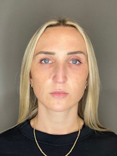 Sculptra Before & After Gallery - Patient 519244 - Image 2