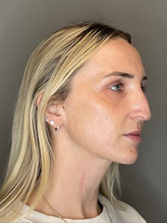 Sculptra Before & After Gallery - Patient 519244 - Image 3