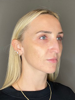 Sculptra Before & After Gallery - Patient 519244 - Image 4