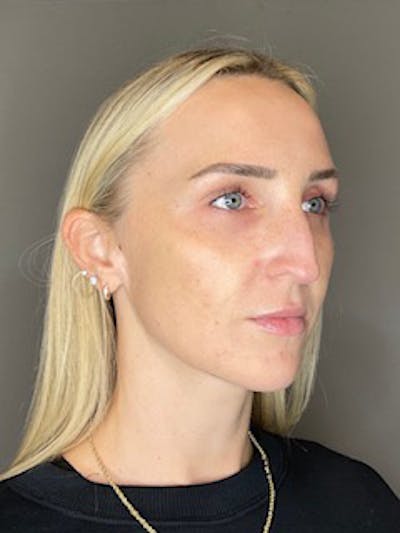 Sculptra Before & After Gallery - Patient 519244 - Image 4