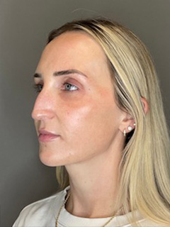 Sculptra Before & After Gallery - Patient 519244 - Image 5