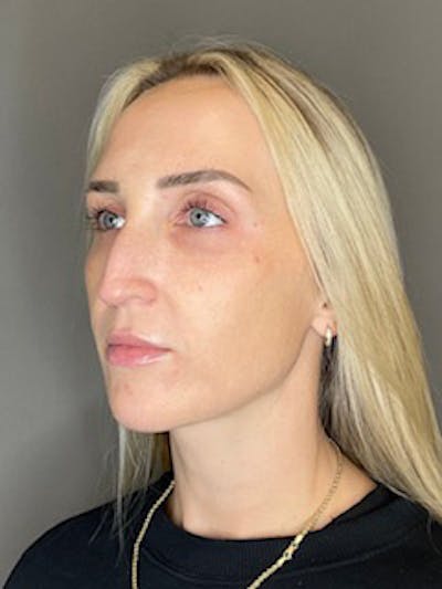 Sculptra Before & After Gallery - Patient 519244 - Image 6