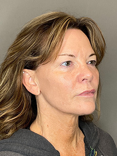 Laser Skin Resufacing Before & After Gallery - Patient 296573 - Image 3