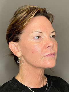 Laser Skin Resufacing Before & After Gallery - Patient 296573 - Image 4
