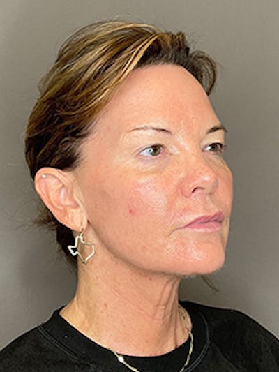 Laser Skin Resufacing Before & After Gallery - Patient 296573 - Image 4