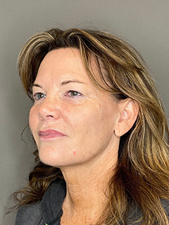 Laser Skin Resufacing Before & After Gallery - Patient 296573 - Image 5