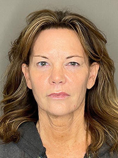 Laser Skin Resufacing Before & After Gallery - Patient 296573 - Image 2