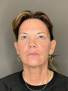 Laser Skin Resufacing Before & After Gallery - Patient 296573 - Image 1