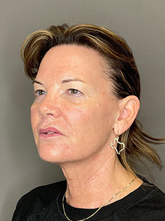 Laser Skin Resufacing Before & After Gallery - Patient 296573 - Image 6