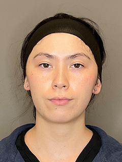 BioRePeel Before & After Gallery - Patient 180915 - Image 2