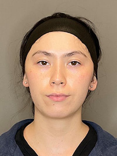 BioRePeel Before & After Gallery - Patient 180915 - Image 2