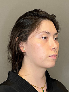 BioRePeel Before & After Gallery - Patient 180915 - Image 3