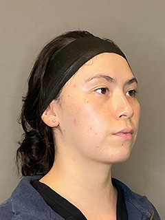 BioRePeel Before & After Gallery - Patient 180915 - Image 4