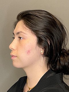 BioRePeel Before & After Gallery - Patient 180915 - Image 5